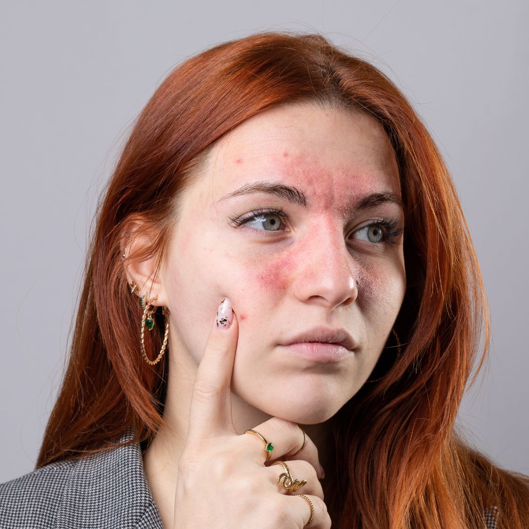 Vad är rosacea?