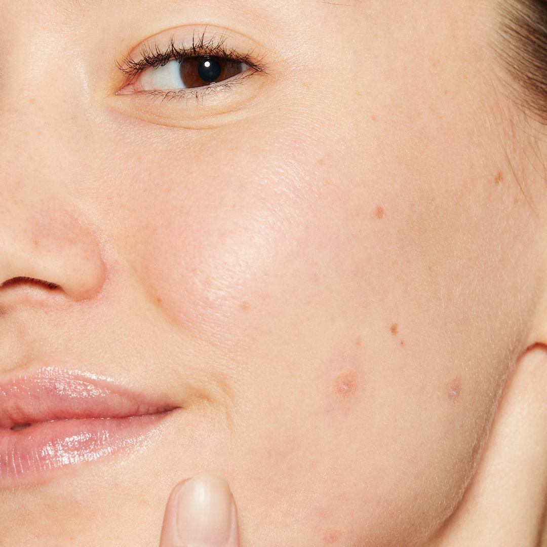 Dermalogica Deep Breakout Liquid Patch