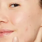 Dermalogica Deep Breakout Liquid Patch